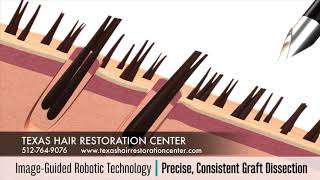 FUE Hair Transplant Surgery ARTAS vs HandHeld FUE Devices [upl. by Tshombe]