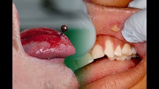 The Problem with Tongue Piercings 👅 Risks Complications Tips [upl. by Ricca247]