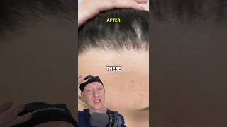 How I Got An INCREDIBLE Hairline Lowering Result [upl. by Markiv]