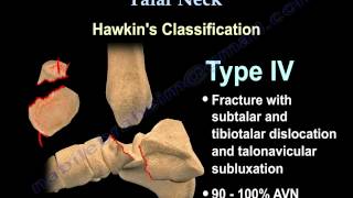 Talus fracture Hawkins Classificaiton  Everything You Need To Know  Dr Nabil Ebraheim [upl. by Sankaran]