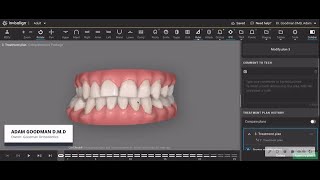 The unforeseen consequences of removing four premolars for orthodontic treatment [upl. by Milka209]