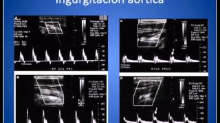 Analisis Onda Espectral Arterias Carótidas y Vertebrales [upl. by Yniar]