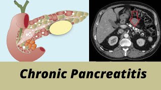 Chronic pancreatitis For MBBS students Neet PG Usmle I Neet Usmle Preparation [upl. by Netsrijk]