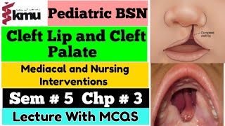 Cleft Lip and Cleft Palate  Pediatric Health NursingChap  3  BSN Sem 5th With MCQS Farman KMU [upl. by Manara]