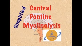 Central Pontine Myelinolysis Osmotic Demyelination Syndrome HYPONATREMIA in 6 min COMLEX USMLE [upl. by Aroc445]