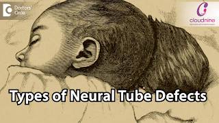 What are the types of Neural Tube Defects  DrTanushri Mukherjee of Cloudnine Hospitals [upl. by Blinny]