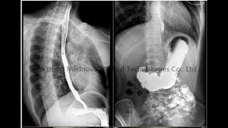 Fluoroscopy image from Digital Fluoroscopy amp Radiography system [upl. by Ahsirak]