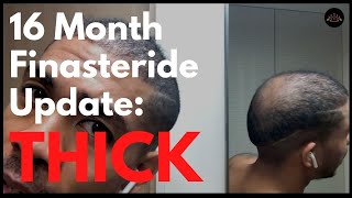 16 Month Before and After Finasteride Update [upl. by Myrilla]