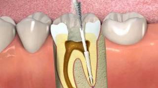 ProPoint How to obturate a root canal with SmartSeal [upl. by Day]