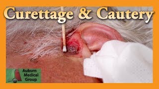 Curettage and Cautery for Basal Cell Carcinoma  Auburn Medical Group [upl. by Nila460]