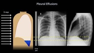 How to Interpret a Chest XRay Lesson 6  Diaphragm and Pleura [upl. by Elleinod]