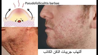 pseudofolliculitis barbae التهاب جريبات الذقن الكاذب [upl. by Gibeon]