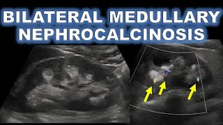 MEDULLARY NEPHROCALCINOSIS ON ULTRASOUND [upl. by Eenot]