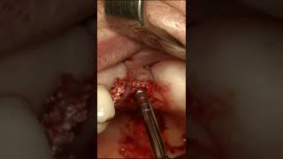 Transalveolar Sinus Elevation and Roll Flap Technique [upl. by Lathe]