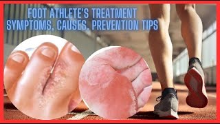 Foot athlete’s treatment symptoms causes prevention tips ytshorts HEALTH [upl. by Matthei]