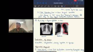 BRONCHIAL ASTHMA For University Studentsl Dr Sahil Bansal [upl. by Vasya991]