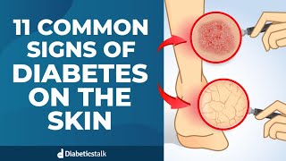 11 Common Signs of Diabetes on The Skin [upl. by Lletnahc870]