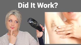 SmoothFit Pure IPL Hair Removal At Home  Did It Work [upl. by Suanne770]