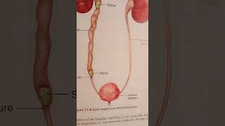 Hydronephrosis Hydroureter [upl. by Seroka29]