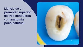 Manejo de un premolar superior de tres conductos con anatomía poco habitual [upl. by Miyasawa]