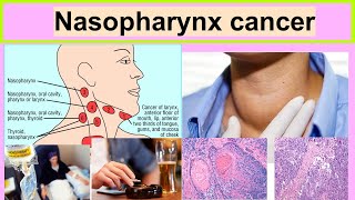 nasopharynx cancer [upl. by Adilem]