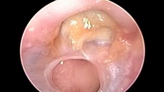 Safe as well as Unsafe Ear Disease CSOM in Same Ear on Otoendoscopy [upl. by Drye]