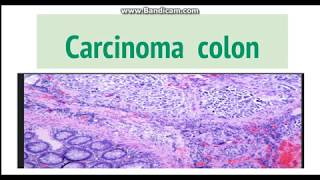 Carcinoma colon Pathogenesis Morphology and clinical features [upl. by Seafowl]