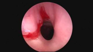 Subglottic stenosis [upl. by Meela]