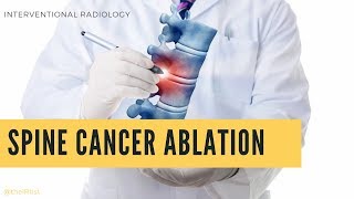 Ablation Cancer Colonne Vertébrale  Spine Cancer Ablation [upl. by Leumel]