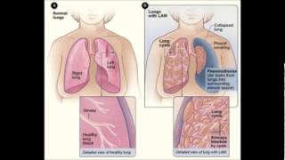 Lymphatic system diseases [upl. by Amleht689]