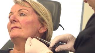 Volumetric Facelift  Nonsurgical full facelift [upl. by Stalder989]