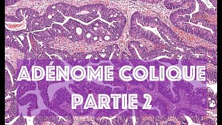 LADENOME COLORECTAL partie 2  PATHOLOGIE [upl. by Longo]