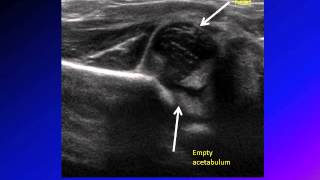 DDH developmental dysplasia of hip congenital hip dislocation CHD [upl. by Booma]