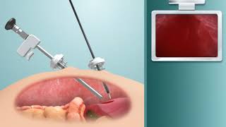 Short Animation of ClickClean Leparoscope Lens Cleaning Device [upl. by Oiratnom]