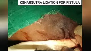 fistula in ano ksharsutra ligation  fistula treatment by ksharsutra anorectal anatomy [upl. by Lunetta]