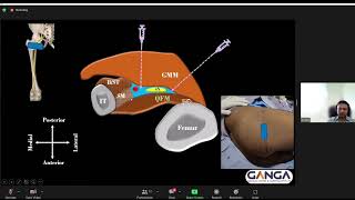 ULTRASOUNDGUIDED SUPRACLAVICULAR NERVE BLOCK [upl. by Aivonas]