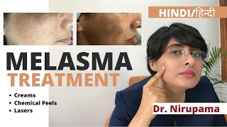 Melasma Treatment Melasma Treatment cream Melasma treatment laser Melasma treatment in Hindi [upl. by Eidnew421]