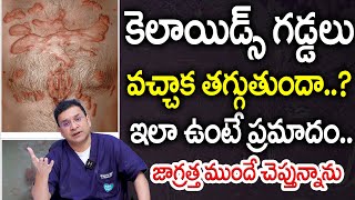 Dr Movva Srinivas  What is the best treatment for Keloid in young people  Dr MOvva [upl. by Hein]