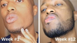 Minoxidil Beard Journey 3 Month Transformation [upl. by Gnok]