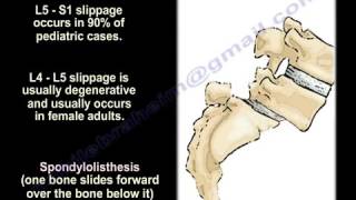 SpondylolysisSpondylolisthesisSpondylitis Spondylosis EverythingYou Need To Know Dr Nabil Ebraheim [upl. by Ayyn483]