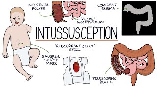 Understanding Intussusception [upl. by Tod520]