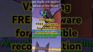 VSP using FREE software 3D slicer for Mandible reconstruction tutorial slicer oms fibulafreeflap [upl. by Nnyre]