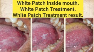 White Patch inside mouthWhite Patch TreatmentWhite Patch Treatment result [upl. by Keon]