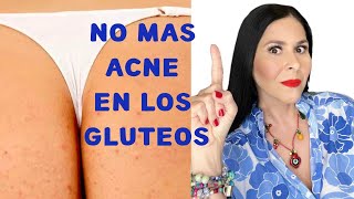 NO MAS ACNE EN GLUTEOS [upl. by Brant646]