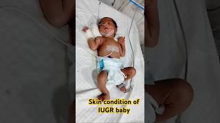 Skin condition of IUGR baby ytshorts shorts trending viralvideo shortsviral new skincare [upl. by Eromle]