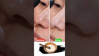 Best home remedy to remove Blackheads amp Whiteheads  How to get rid of pimple on your chin [upl. by Eseerahs]