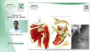 Capsulite Adesiva do Ombro  Dr Luiz Marchese [upl. by Pirnot]