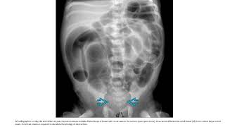 Hirschsprung Disease Imaging [upl. by Cressi719]