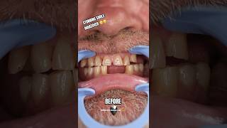 Amazing Clip On Veneers Before and After  Brighter Image Lab shorts [upl. by Morocco]