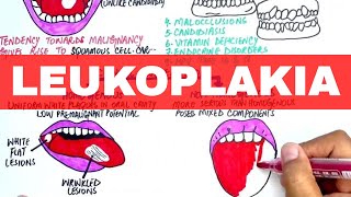 Leukoplakia  Causes Diagnosis amp Treatment [upl. by Cattan]